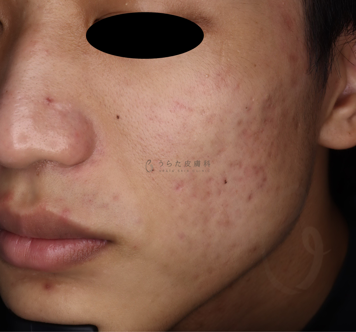 キュアジェット治療2回後