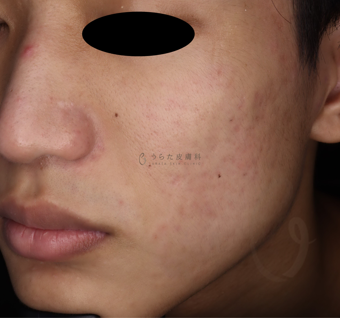 キュアジェット治療3回後