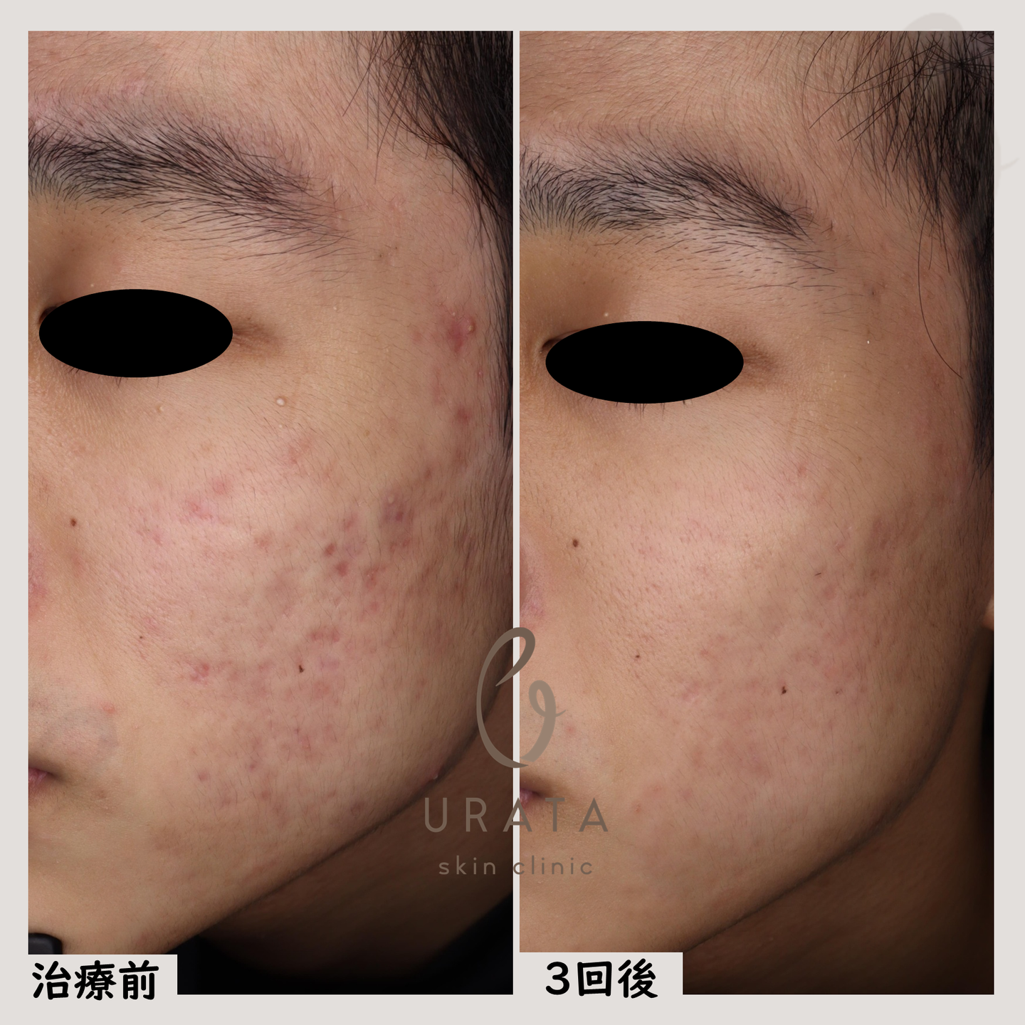 キュアジェットによるニキビ跡治療