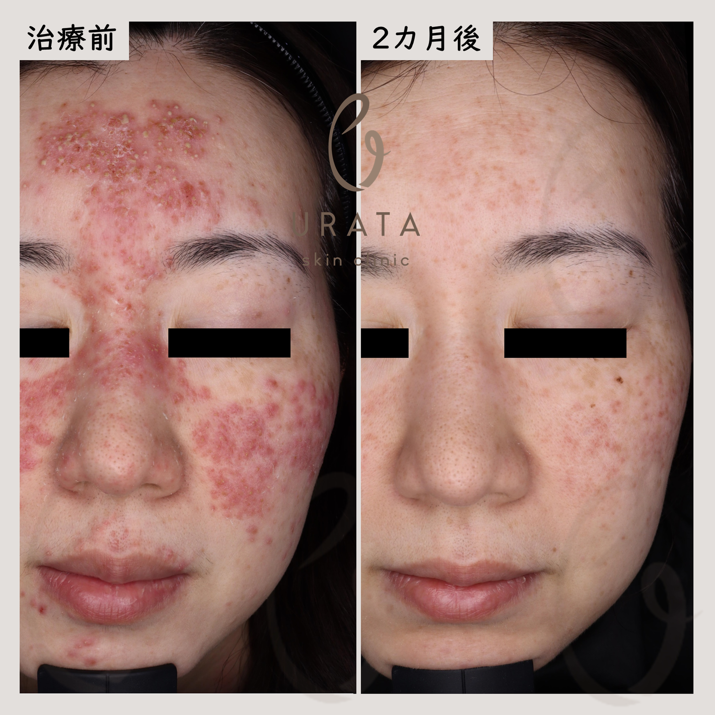 酒さの症例写真１