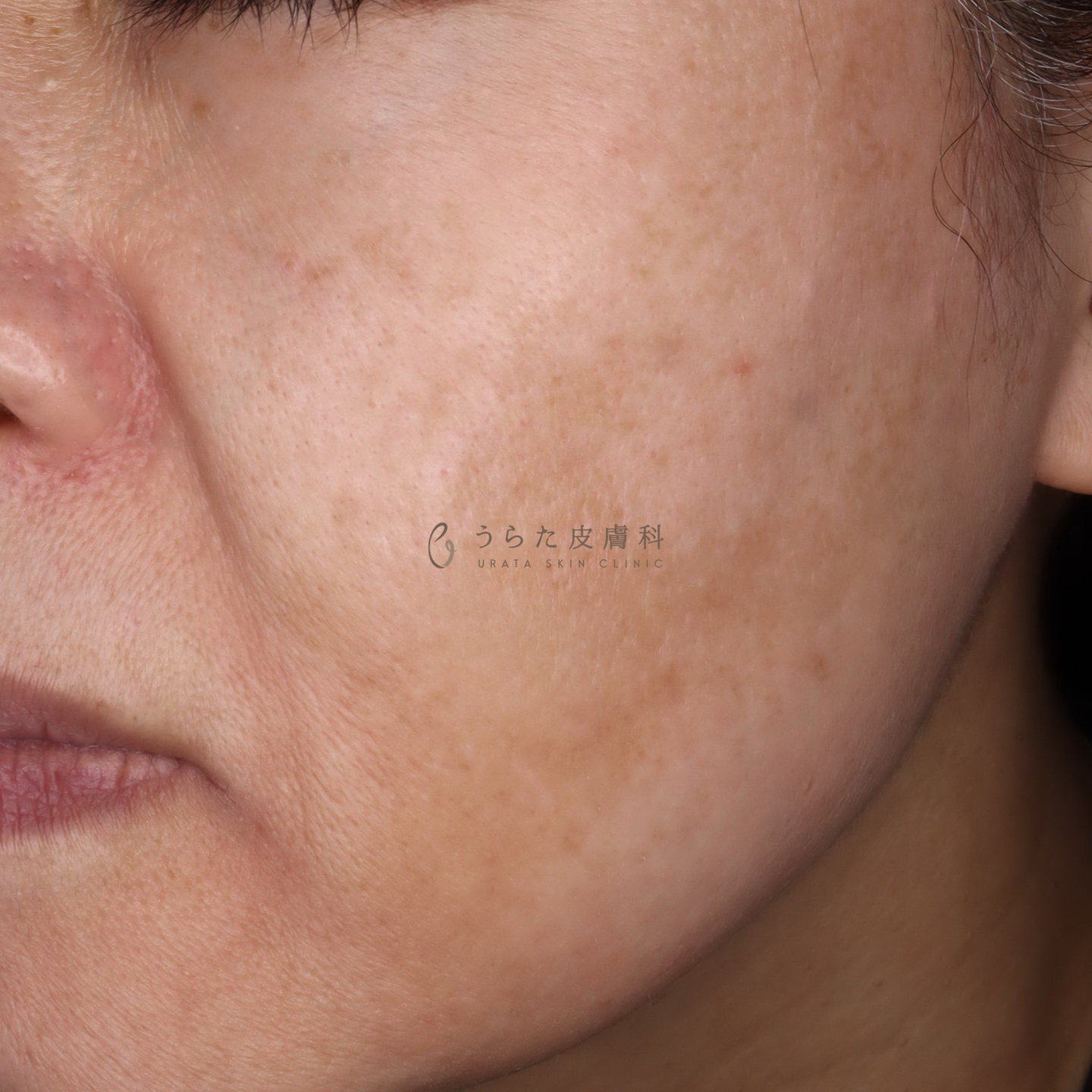 肝斑のゼオスキン治療2周間後