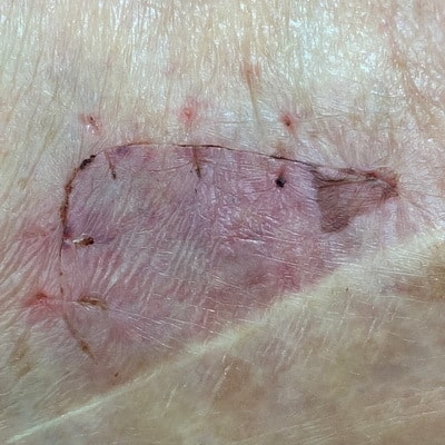 1週間後に元通りにくっつきます