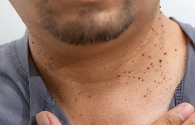 アクロコルドン