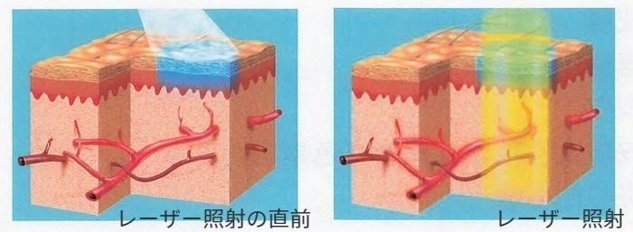 Vbeamの冷却機能