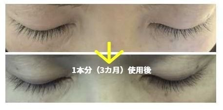ビマトプロストのまつ毛の育毛治療