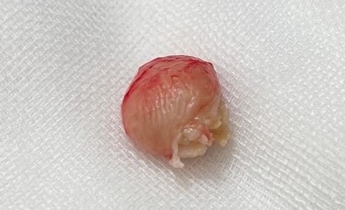 摘出した粉瘤