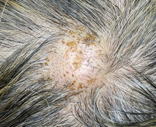 頭部の粉瘤の術前