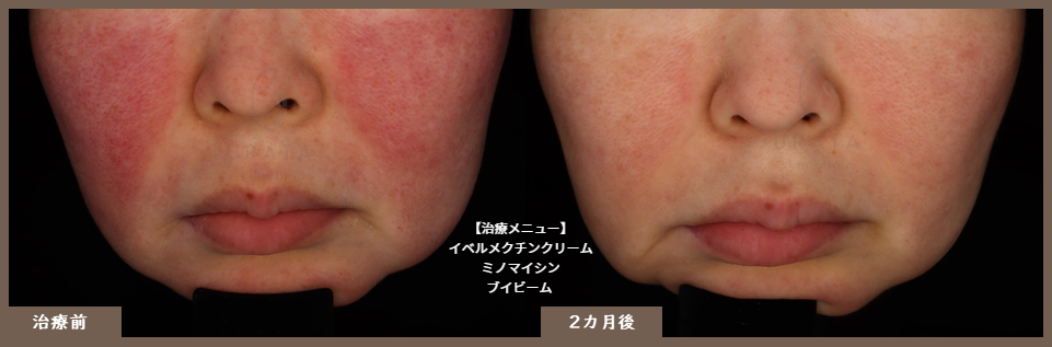 イベルメクチン2カ月後