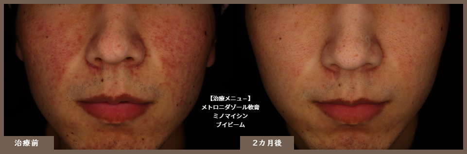 メトロニダゾール2カ月後