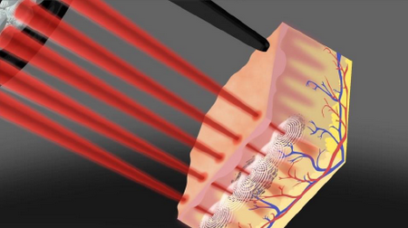 ピコフラクショナルのイメージ画像