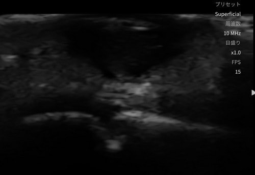 足底粉瘤の術前エコー