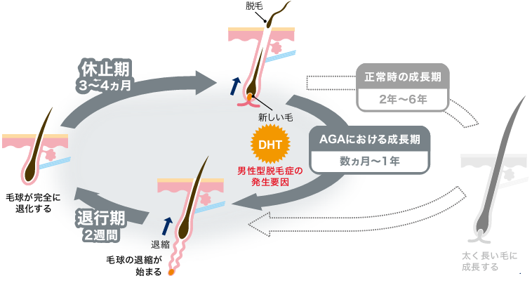 AGAのヘアサイクルの変化
