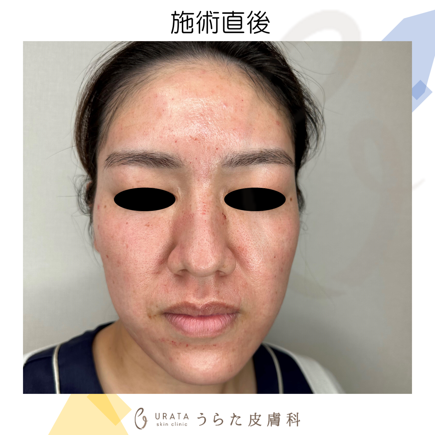 ポテンツァのダウンタイム施術直後　成人女性１