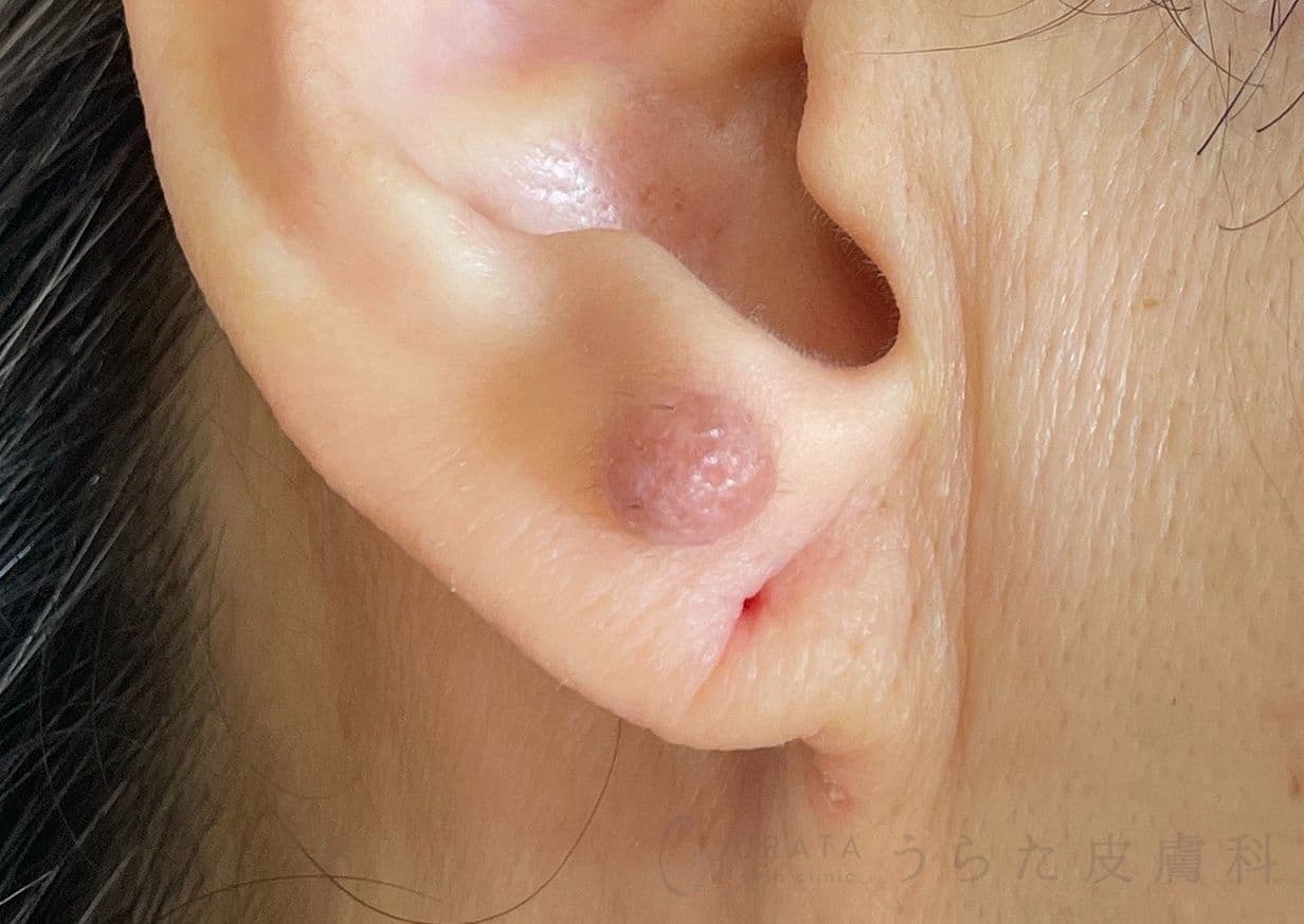 耳のほくろ　手術前