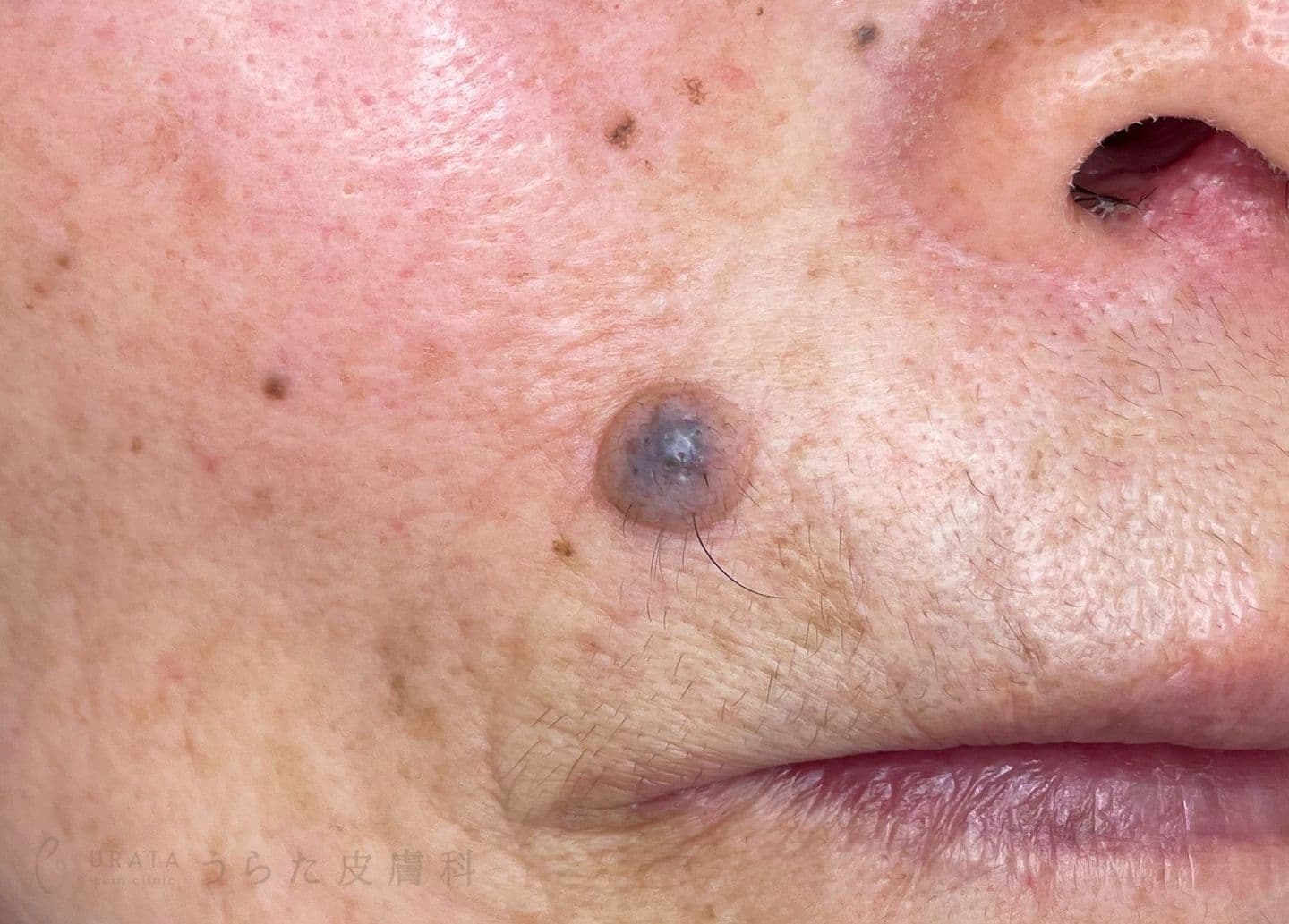 鼻唇溝のほくろ　手術前