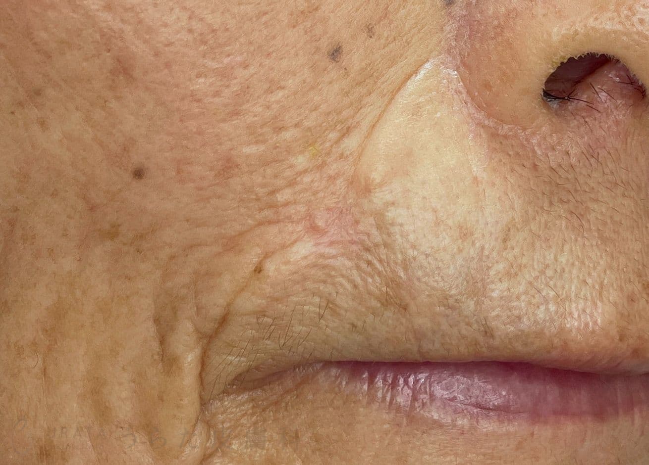 鼻唇溝のほくろ　手術5カ月後