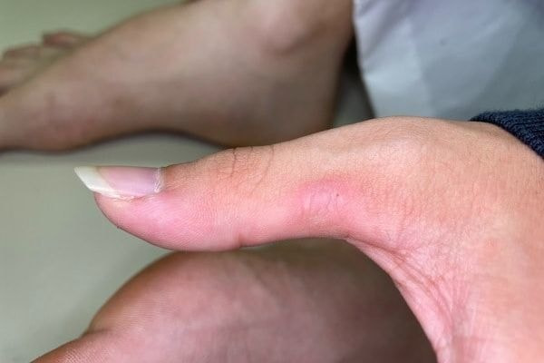 イボ手術1カ月後