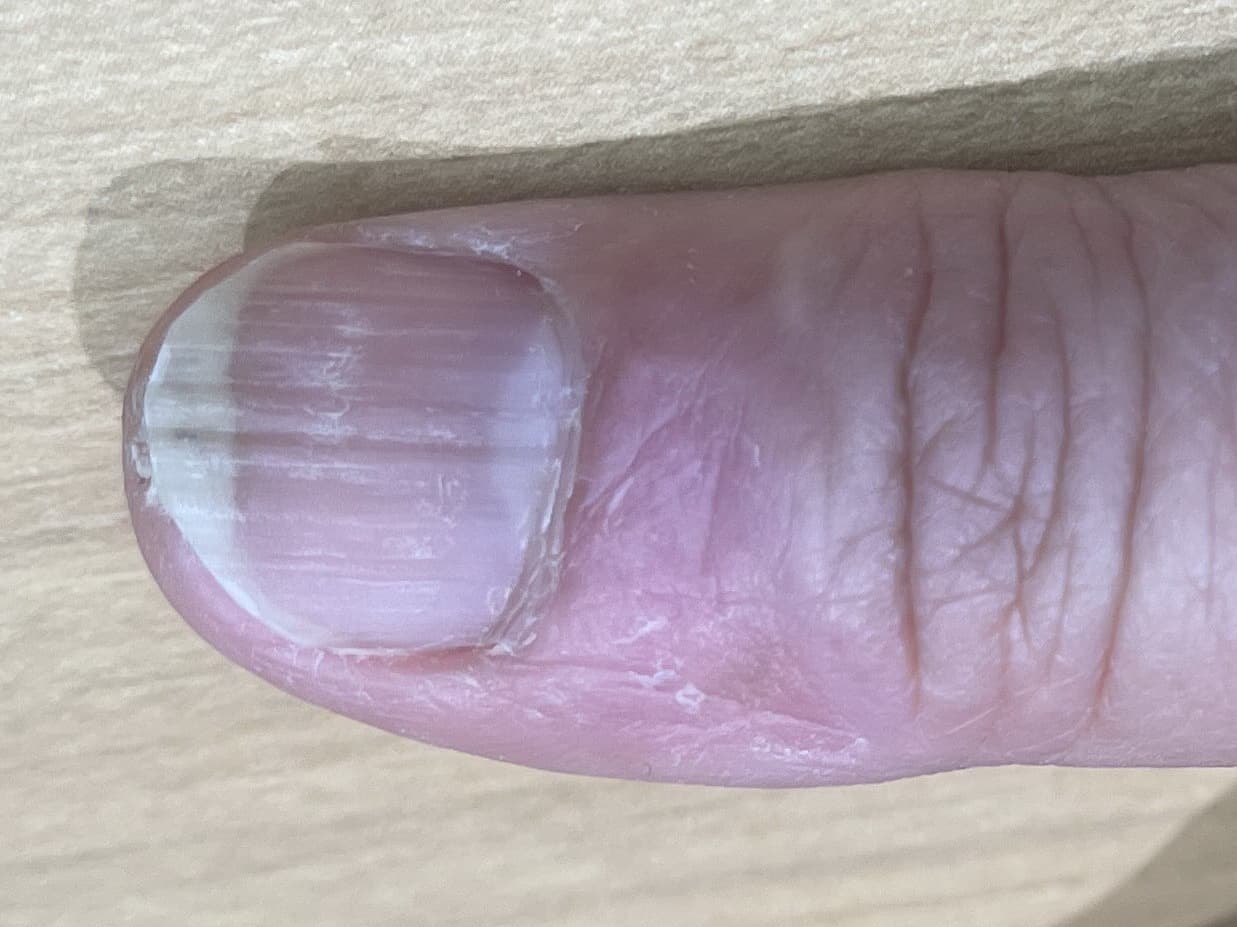 イボのブイビーム治療後