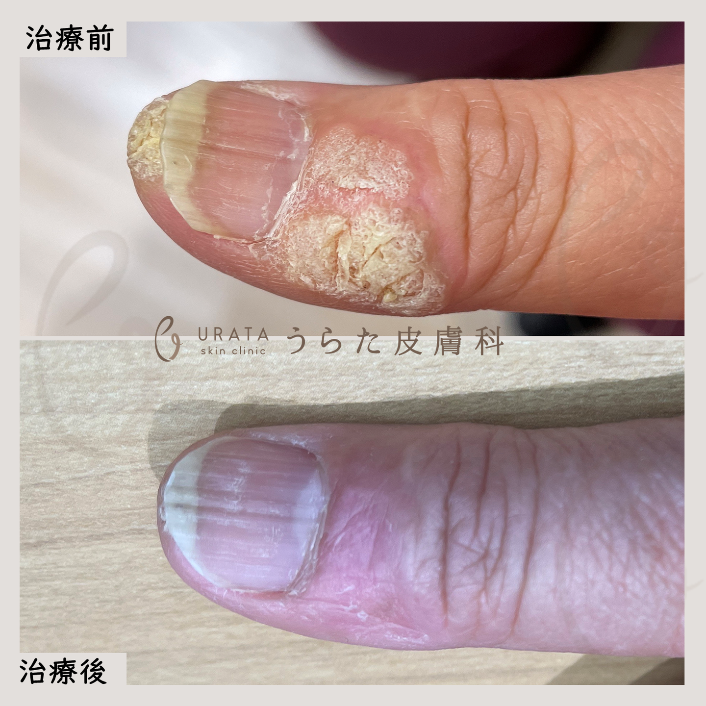 Vビームのウイルス性イボ治療