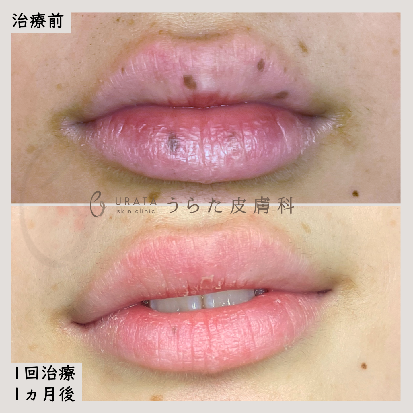 口唇メラノーシスのピコレーザー治療１