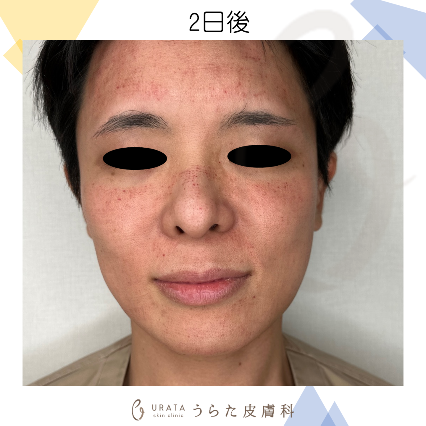 ポテンツァのダウンタイム施術2日後　成人アトピー男性