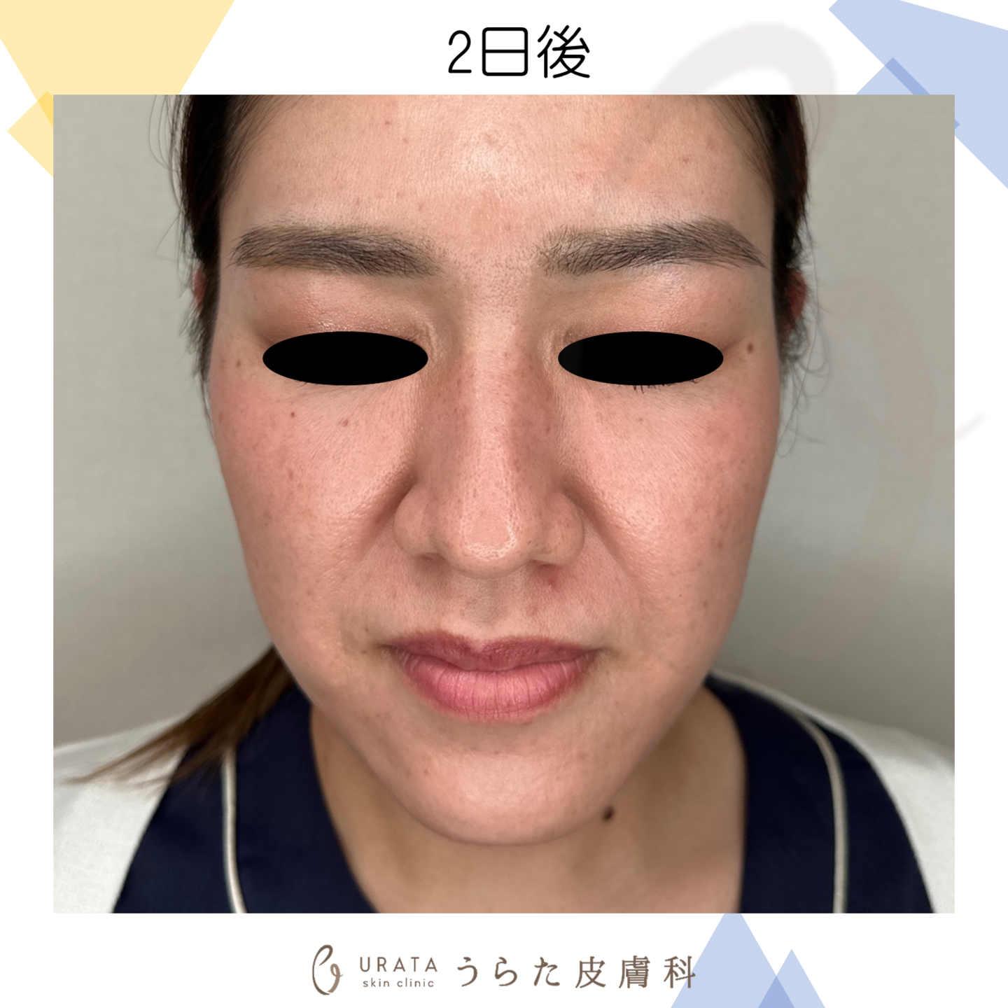 ポテンツァのダウンタイム施術2日後　成人女性