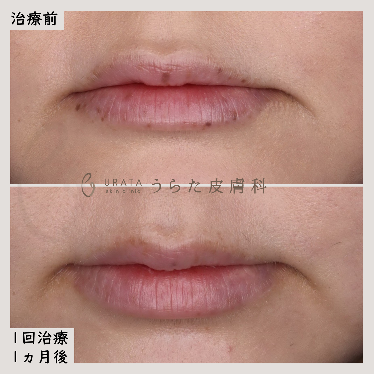 口唇メラノーシスのピコレーザー治療２