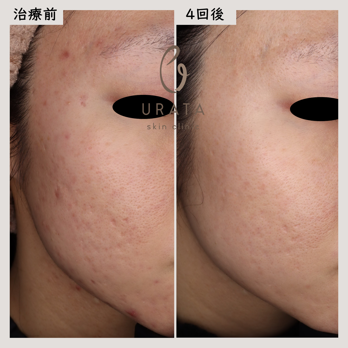 CO2フラクショナルによるニキビ跡治療３