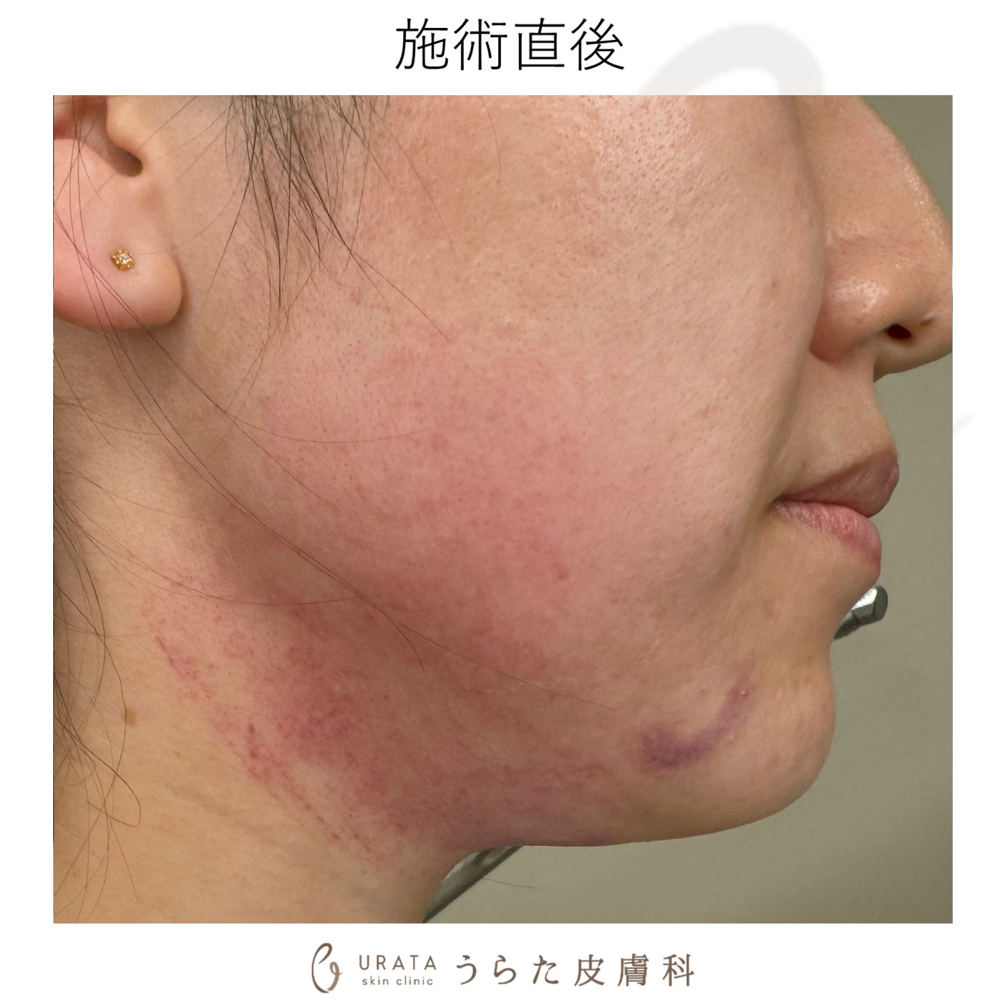 ポテンツァのダウンタイム施術2日後　成人アトピー男性