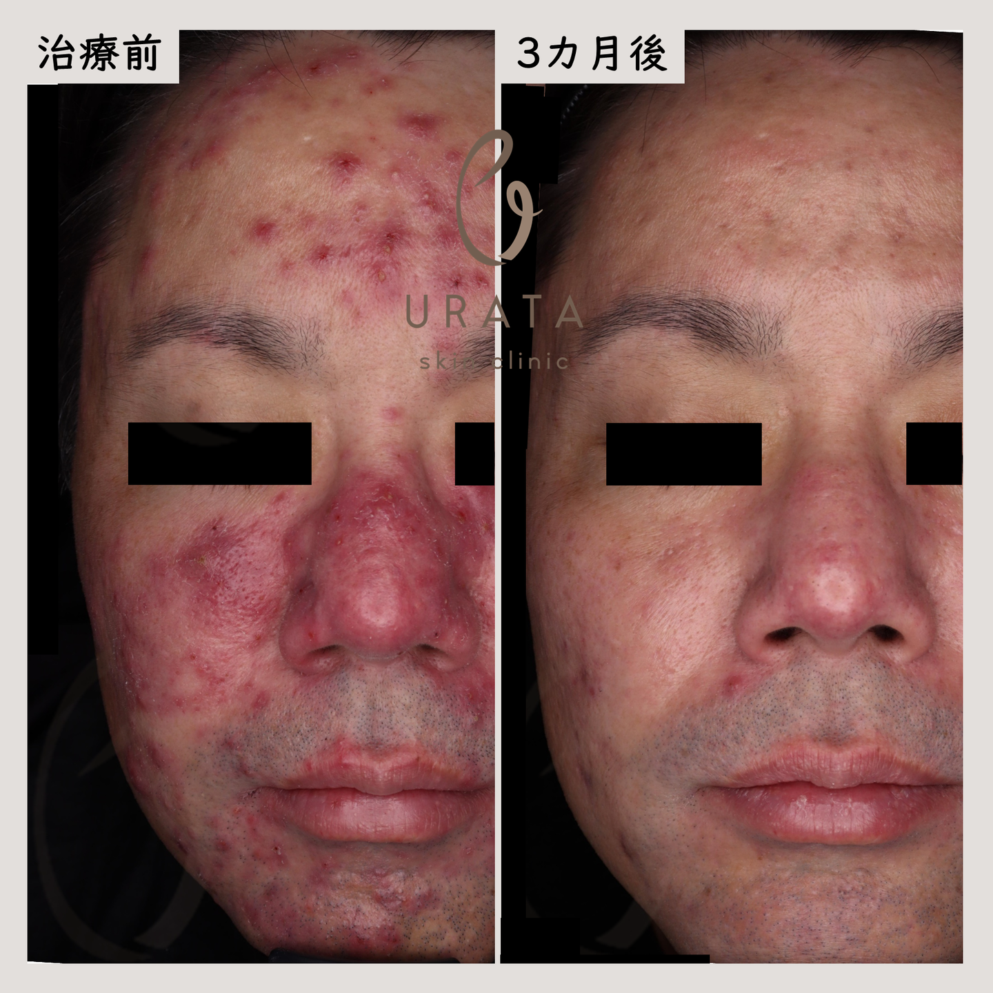 酒さのレーザー治療３