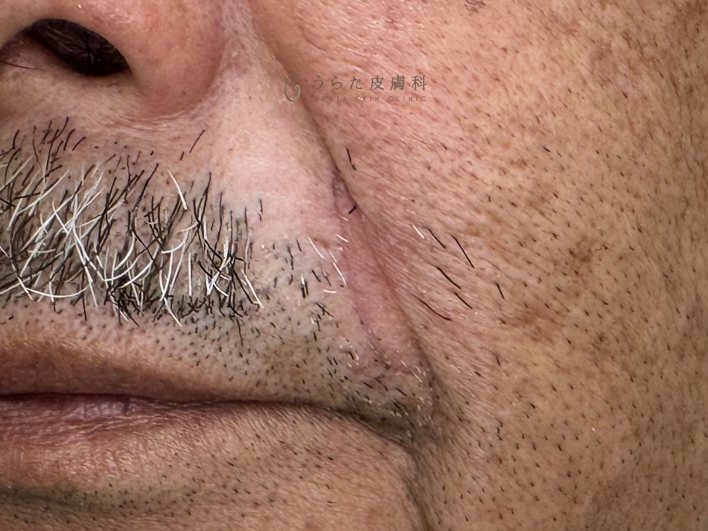 ほうれい線の大き目のほくろの手術後２週間