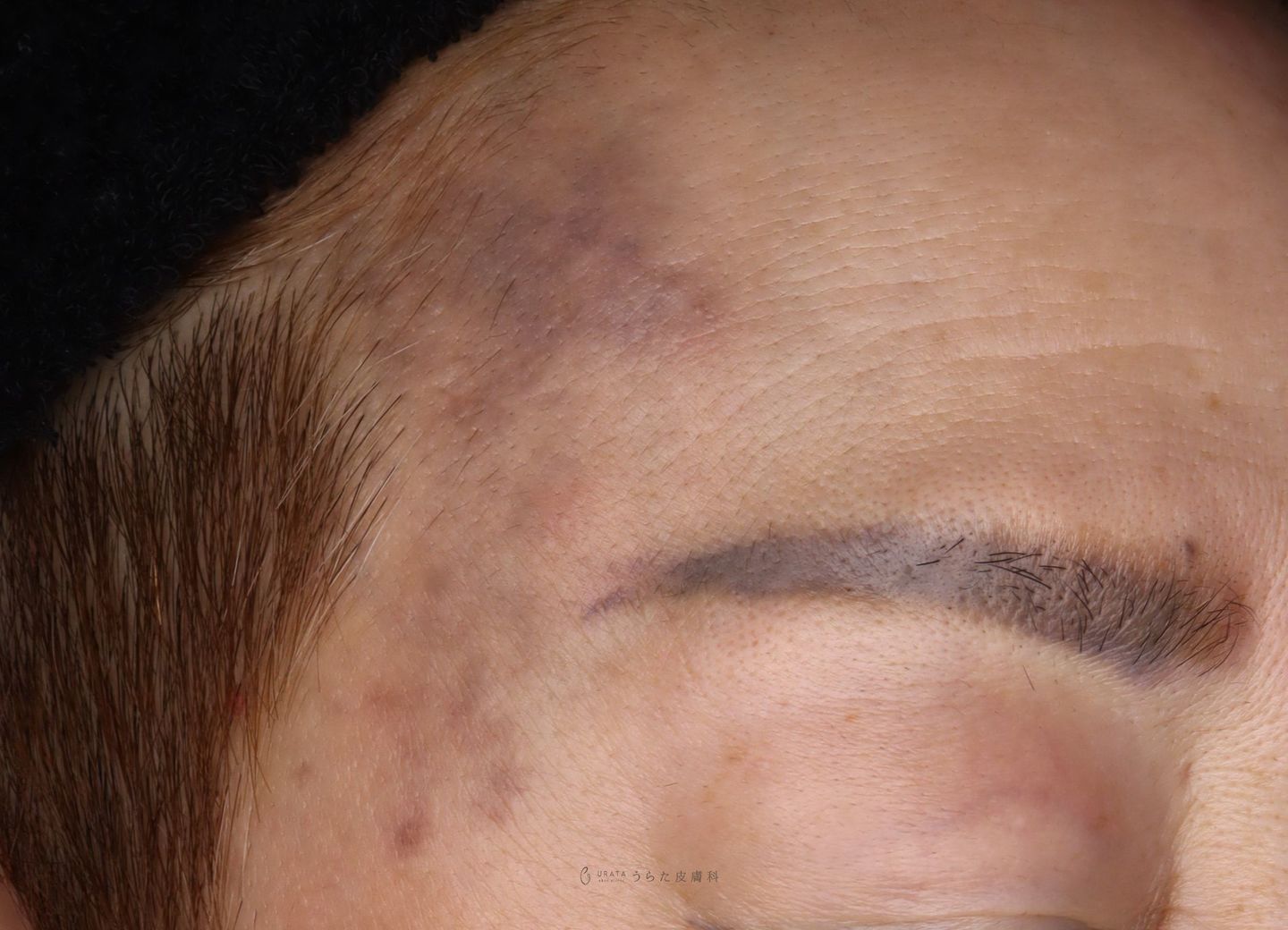 ADMのレーザー治療前