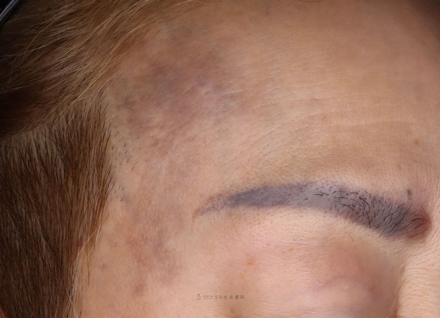 ADMのレーザー治療１回後