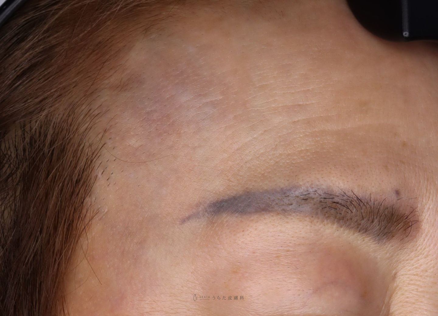 ADMのレーザー治療４