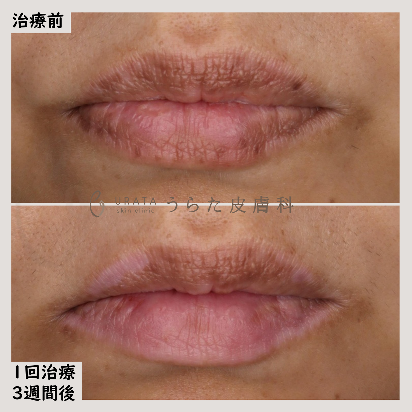 口唇メラノーシスのピコレーザー治療５