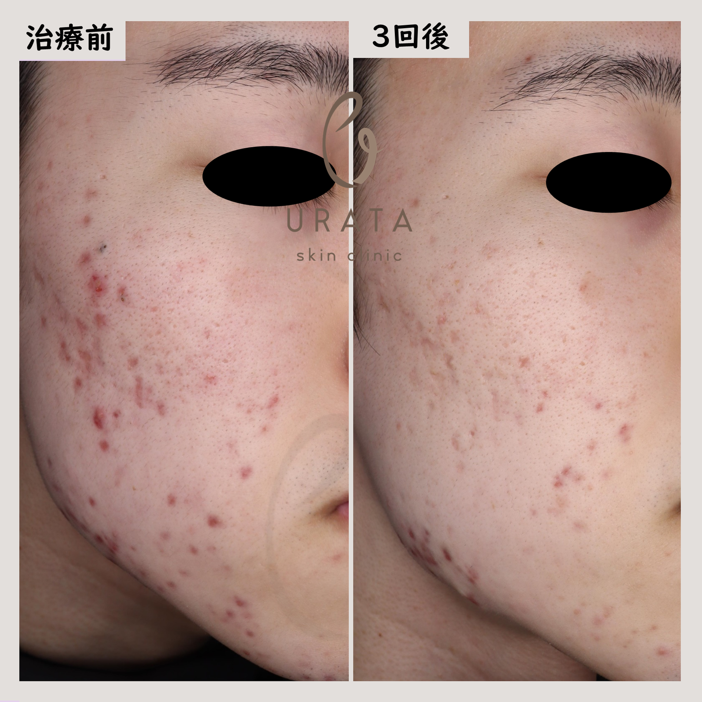 Vビームの赤いニキビ跡治療