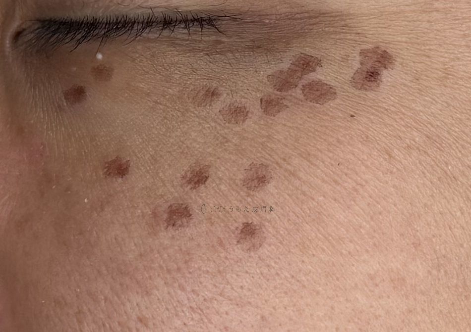 シミのスポット治療翌日