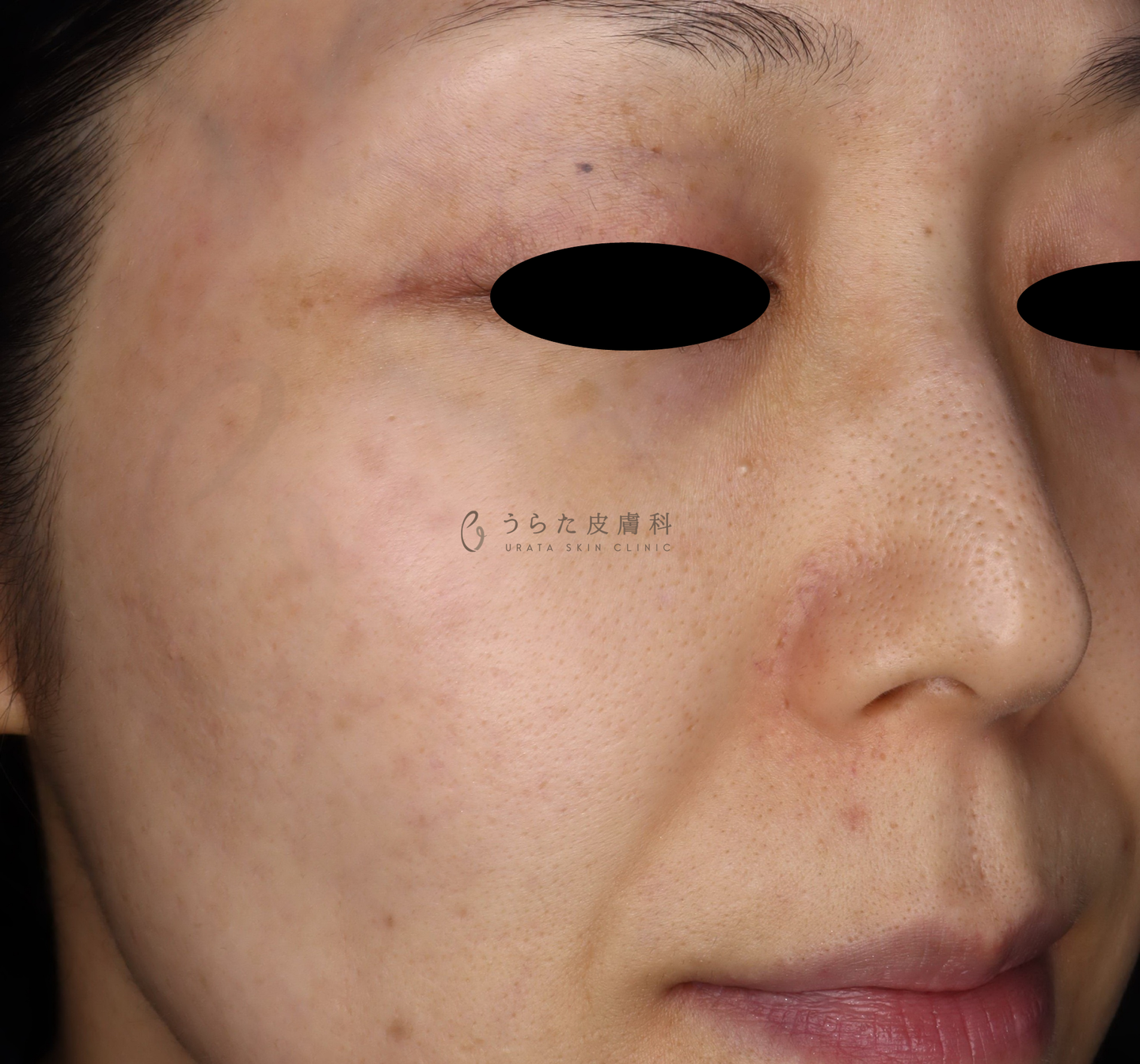 老人性色素斑・ADMのピコトリプル治療2回後