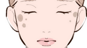 老人性色素斑のイラスト
