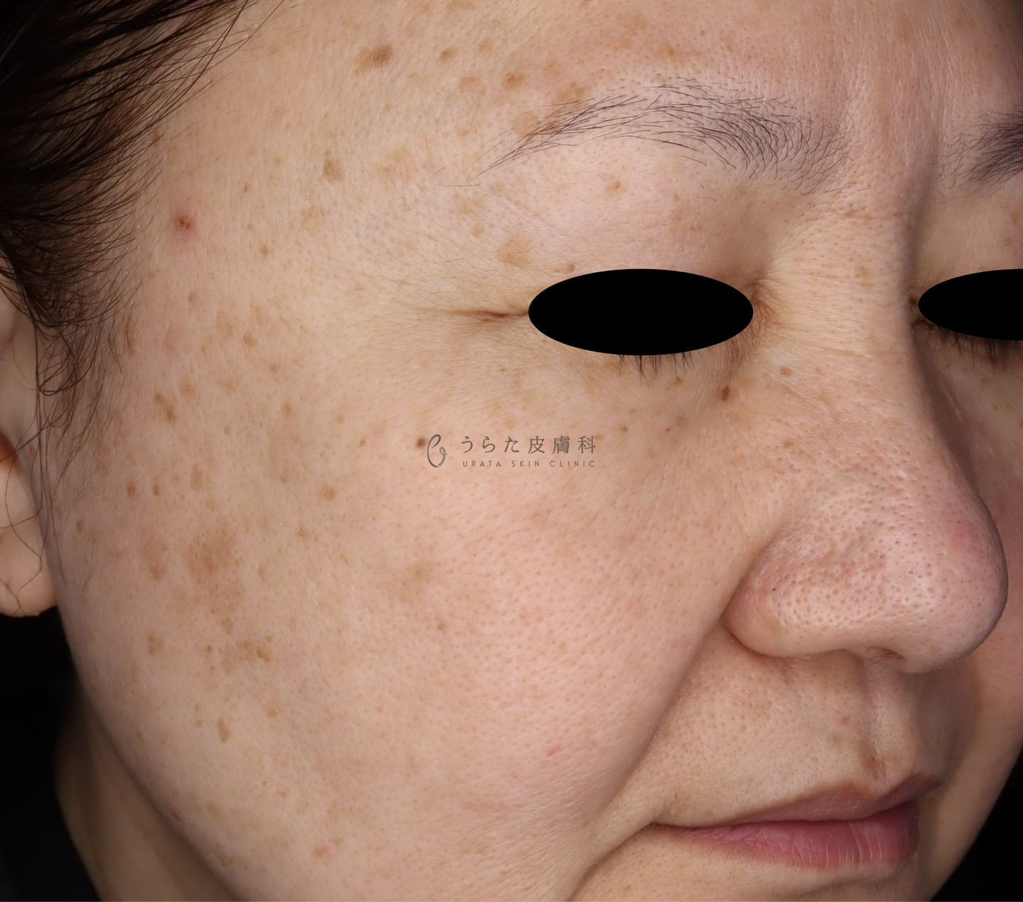 ピコトリプル1回治療後