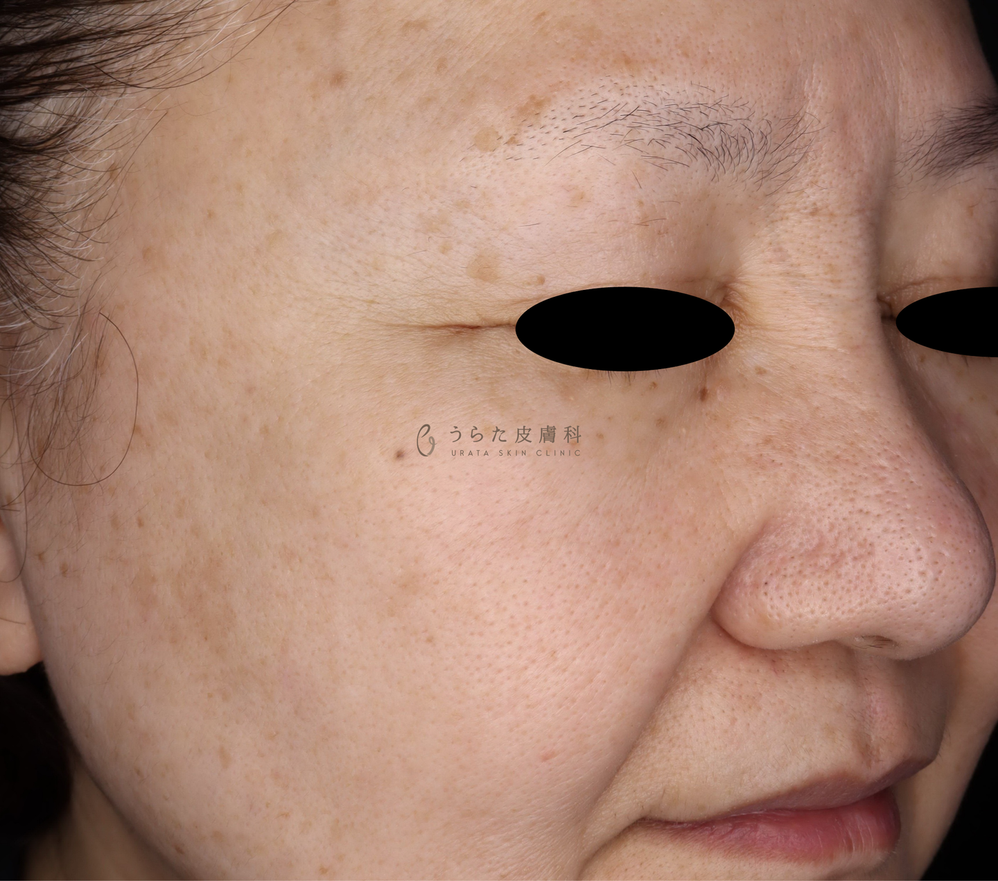 ピコトリプル2回治療後