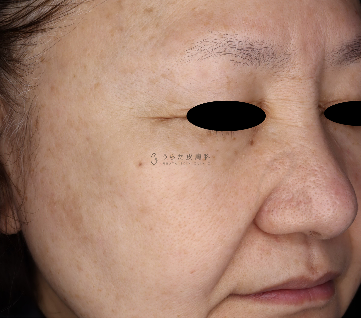 ピコトリプル3回治療後