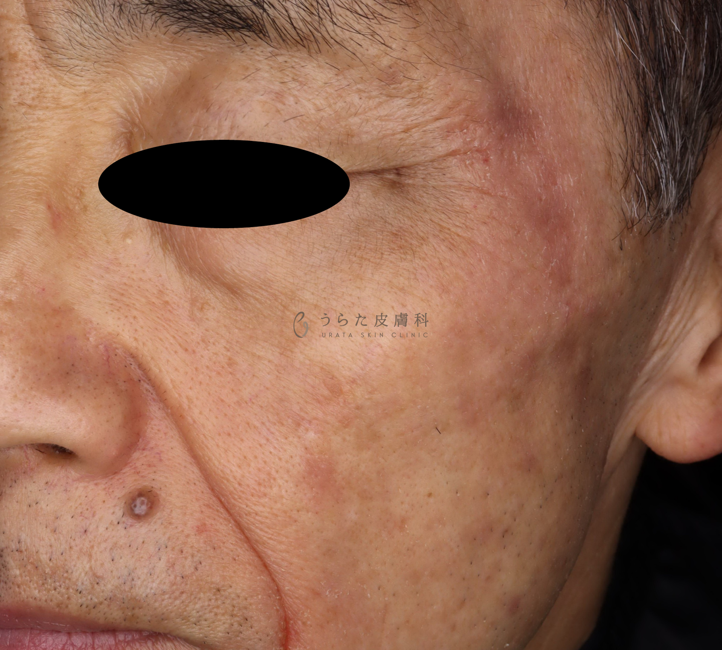 ピコスポット4週間後