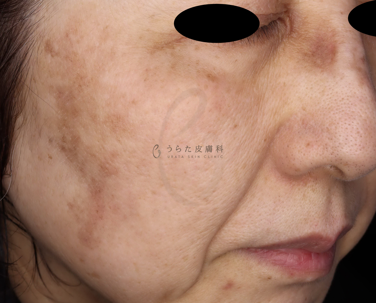 ピコスポット4週間後