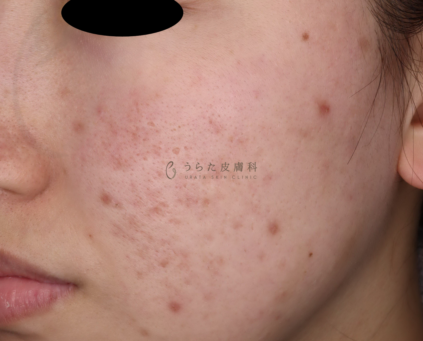 ニキビのポテンツァ治療前