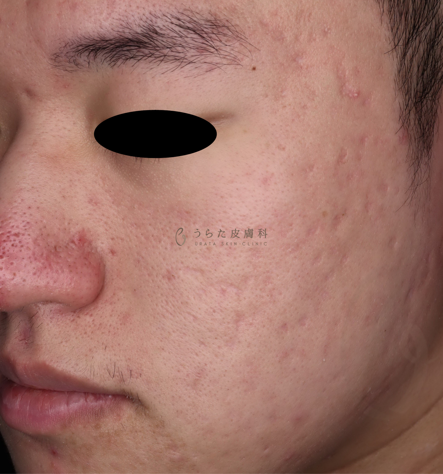 ニキビのポテンツァ治療前