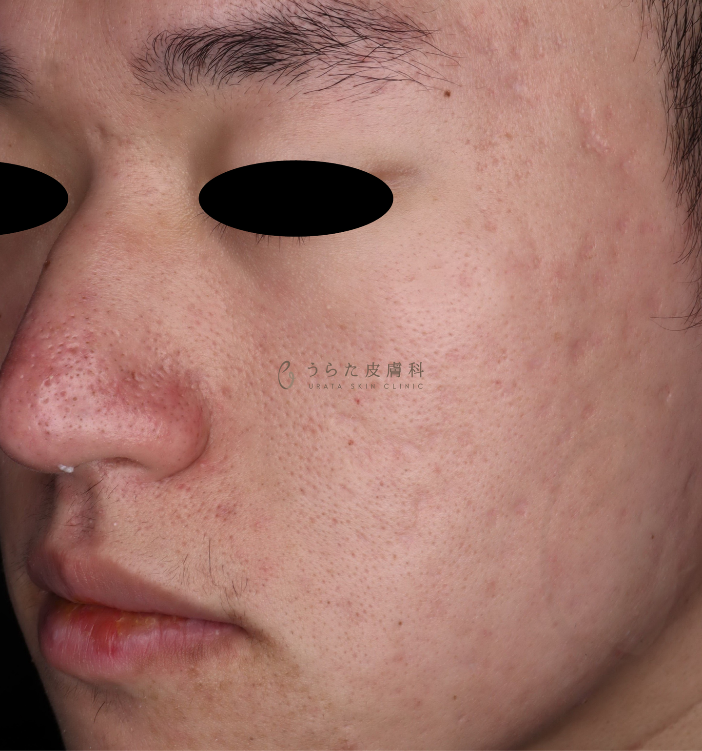 ニキビのポテンツァ3回後