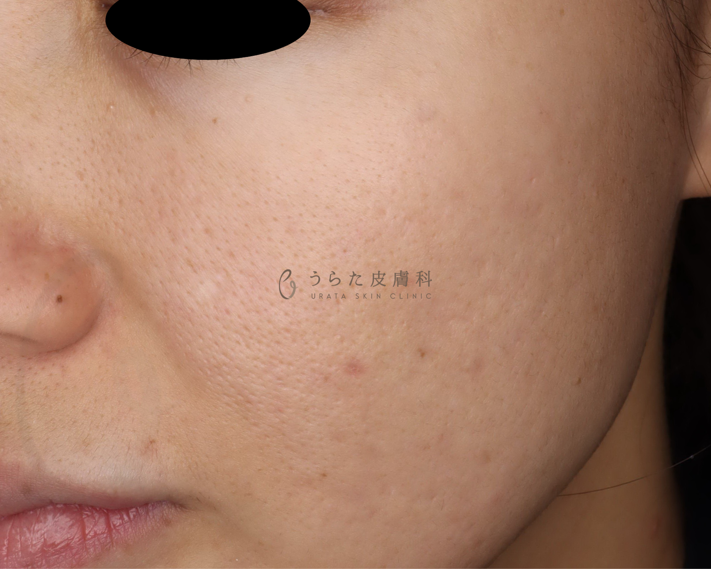 ニキビのポテンツァ1回後