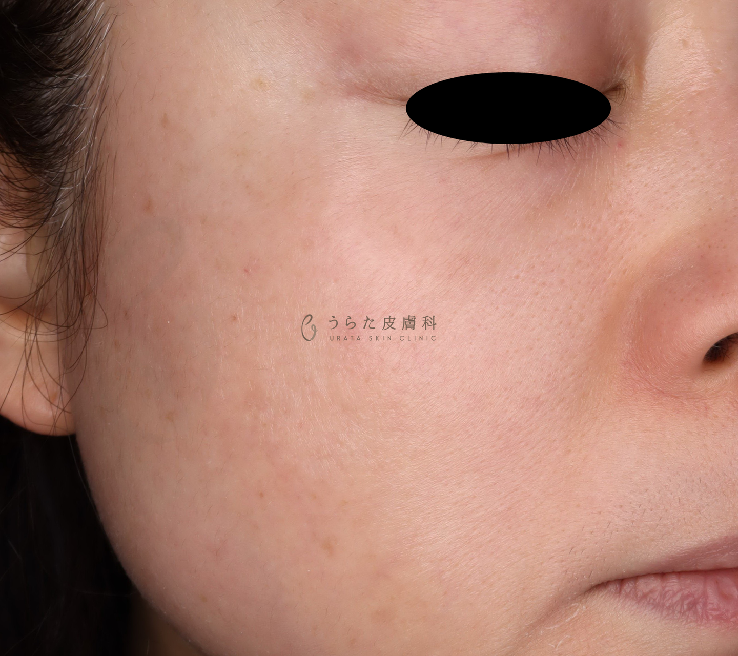 肝斑のゼオスキン治療8週間後