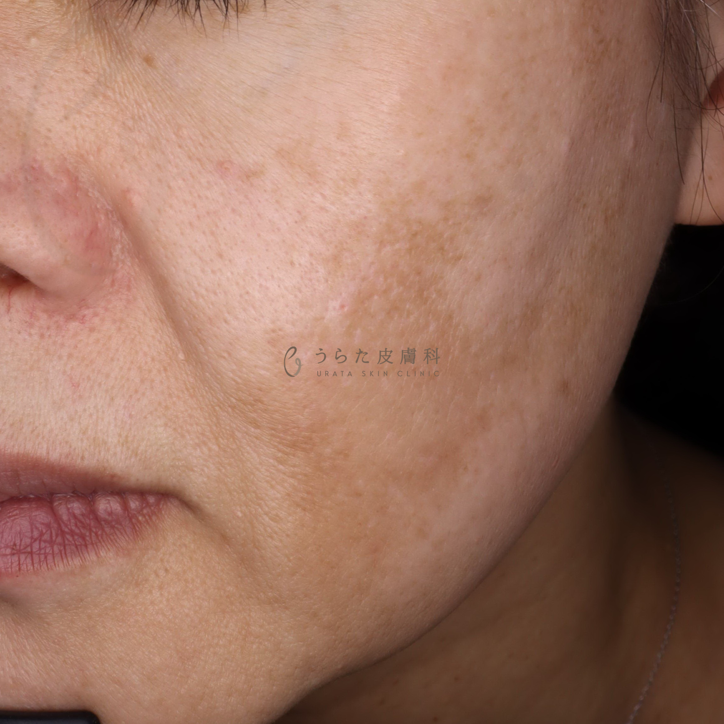 肝斑のゼオスキン治療前